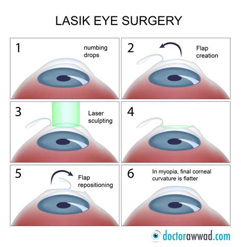 LASIK 